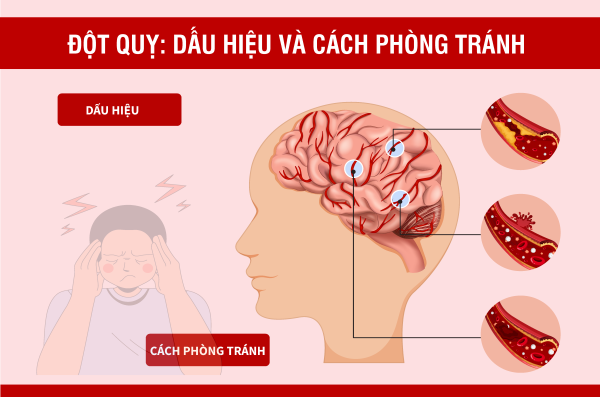 Đột quỵ: Dấu hiệu và cách phòng tránh