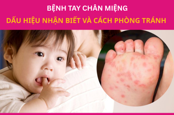 Bệnh tay chân miệng: Dấu hiệu nhận biết và cách phòng tránh